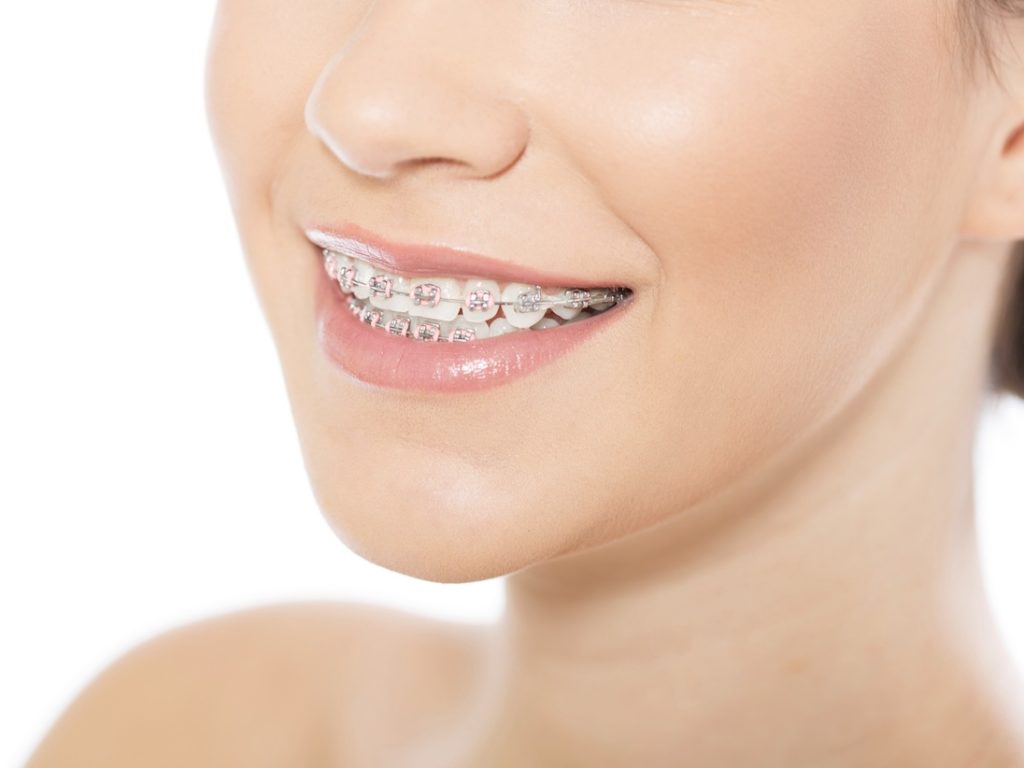 Will I Have To Wear Braces Twice? Morita Orthodontics Blog