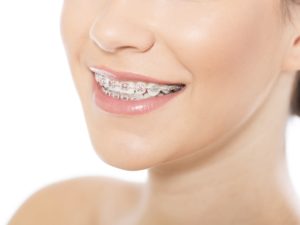 Portrait of beautiful young woman wearing braces, isolated on white