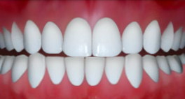 Dental Midlines not Matched