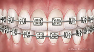 Traditional Metal Braces