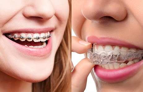 The Traditional Way: Braces