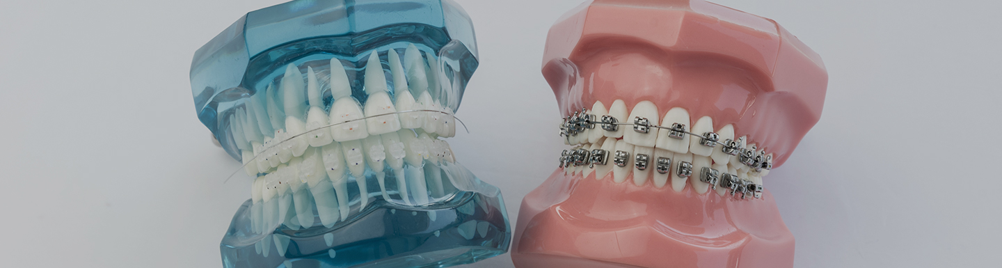 Invisalign vs. Braces in Honolulu