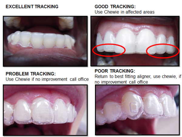 Invisalign Aligners, Check Your Fit