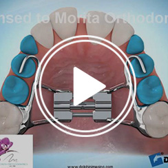 Rapid Palatal Expander