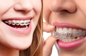 Side by side photos of braces and invisalign in mouths of patients.